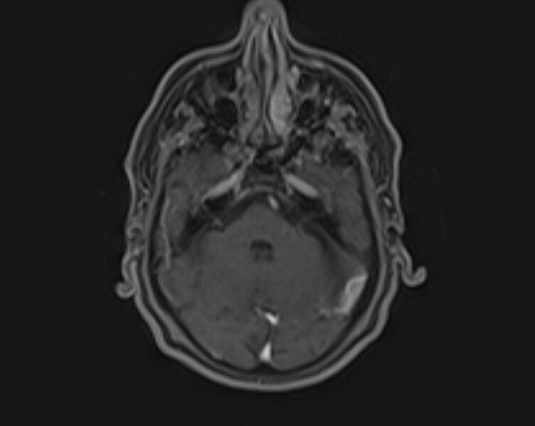 File:Non-Hodgkin lymphoma - parotid gland (Radiopaedia 71531-81890 E 22).jpg