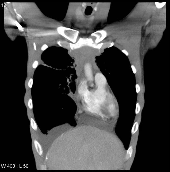 File:Non-Hodgkin lymphoma involving lung (Radiopaedia 29094-29470 C 7).jpg