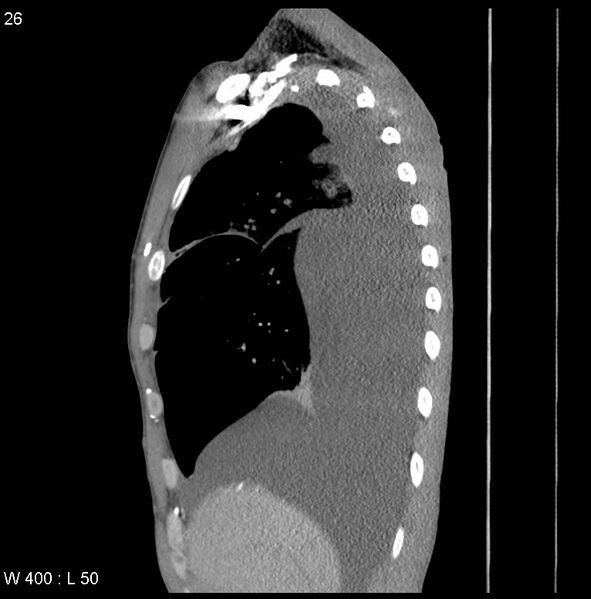 File:Non-Hodgkin lymphoma involving lung (Radiopaedia 29094-29470 D 17).jpg