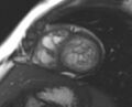 Non-compaction of the left ventricle (Radiopaedia 69436-79314 Short axis cine 94).jpg