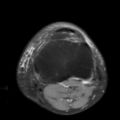 Non-displaced patella fracture (Radiopaedia 15932-15582 Axial PD fat sat 19).jpg