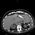 Non Hodgkin lymphoma in a patient with ankylosing spondylitis (Radiopaedia 84323-99621 Axial non-contrast 29).jpg