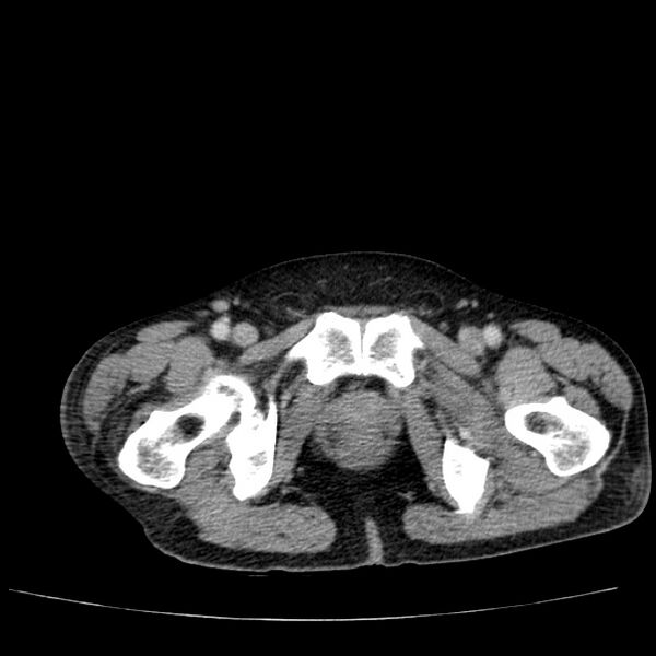 File:Non small-cell lung cancer (Radiopaedia 24467-24769 C+ delayed 119).jpg