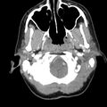 Normal CT of the neck (Radiopaedia 14575-14500 Axial C+ 17).jpg