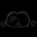 Normal MRI abdomen in pregnancy (Radiopaedia 88001-104541 Axial T2 3).jpg