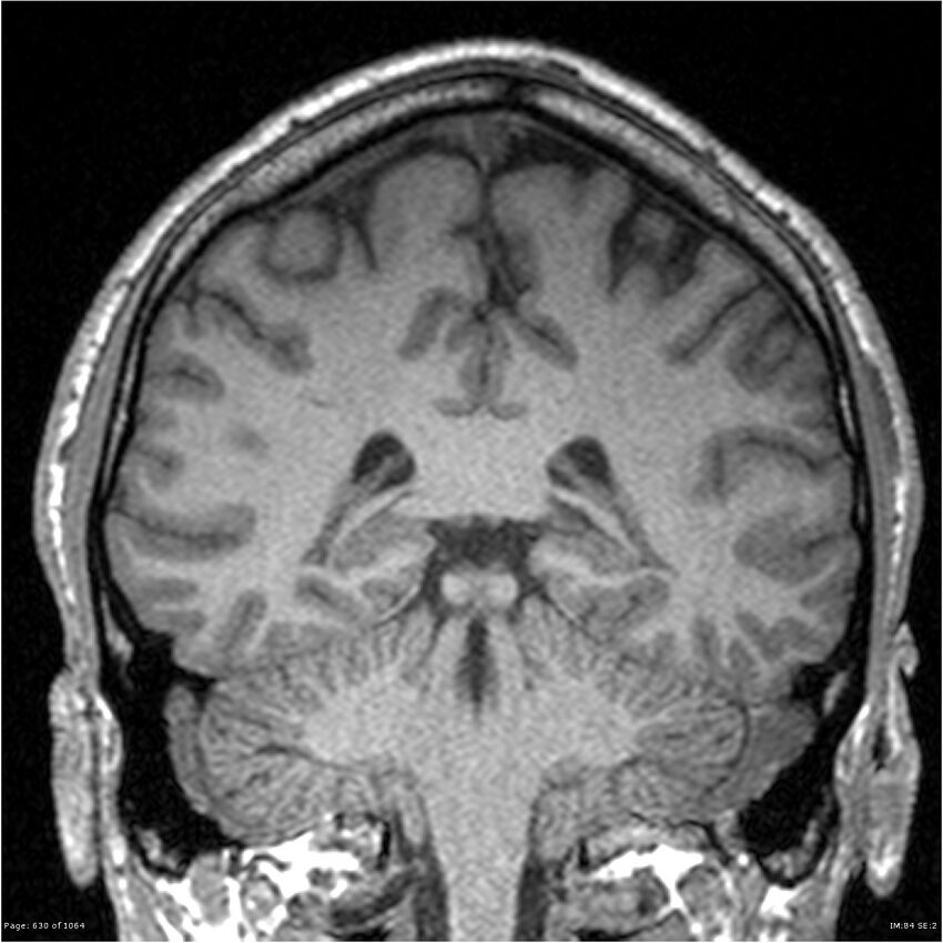 Normal brain MRI (non-focal epilepsy protocol) (Radiopaedia 38571-40700 Coronal T1 41).jpg