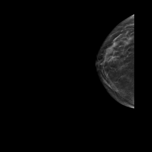 File:Normal breast mammography (tomosynthesis) and ultrasound (Radiopaedia 65325-74353 RCC Tomo 8).jpeg