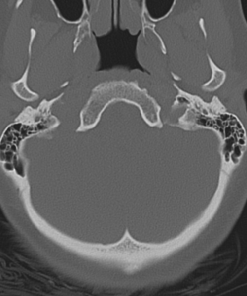 File:Normal cervical spine MRI (including Dixon) (Radiopaedia 42762-45926 Axial bone window 4).png
