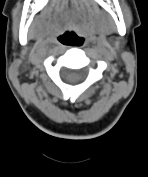 File:Normal cervical spine MRI (including Dixon) (Radiopaedia 42762-45926 Axial non-contrast 18).png