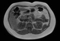 Normal liver MRI with Gadolinium (Radiopaedia 58913-66163 Axial T1 in-phase 17).jpg