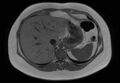 Normal liver MRI with Gadolinium (Radiopaedia 58913-66163 Axial T1 in-phase 24).jpg