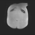 Normal liver MRI with Gadolinium (Radiopaedia 58913-66163 Coronal T2 4).jpg