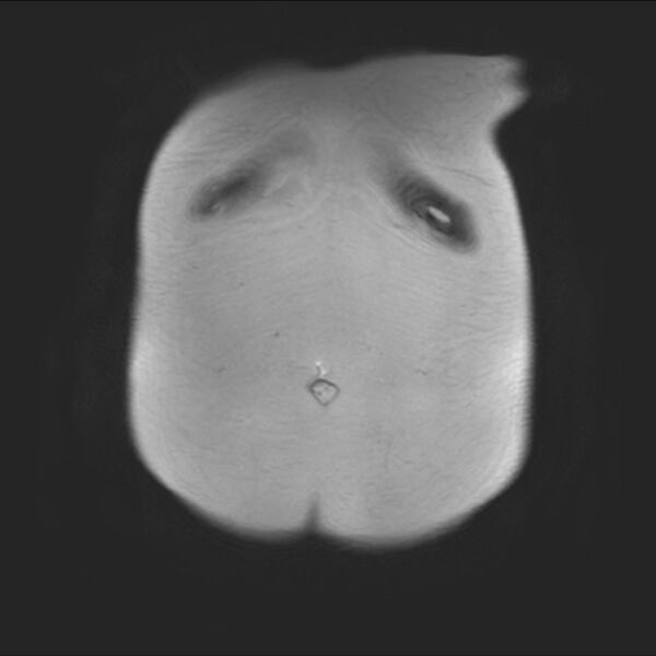 File:Normal liver MRI with Gadolinium (Radiopaedia 58913-66163 Coronal T2 4).jpg