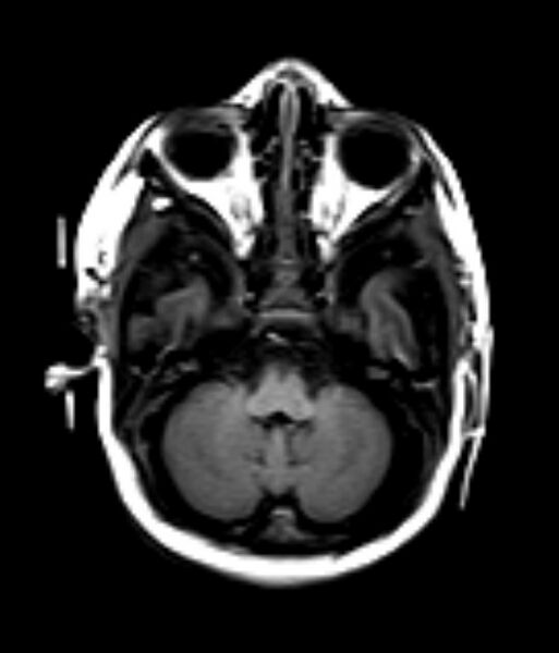 File:Normal myelination in a neonate (Radiopaedia 6810).jpg