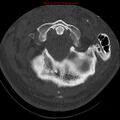 Occipital condyle fracture (Radiopaedia 18366-18208 Axial bone window 14).jpg