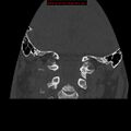 Occipital condyle fracture (Radiopaedia 18366-18208 Coronal bone window 15).jpg