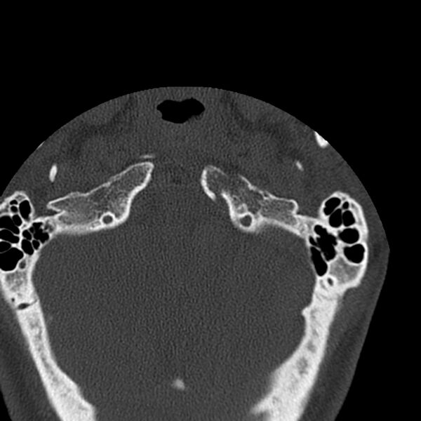 File:Occipital condyle fracture (Radiopaedia 31755-32691 Axial bone window 6).jpg