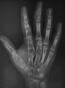 X-ray hand:Ollier disease in child