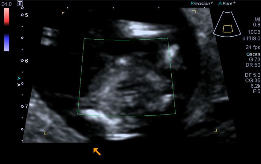 1st trimester nuchal-morphology ultrasound (Radiopaedia 44706-48477 Heart views cine with colour 165).jpg