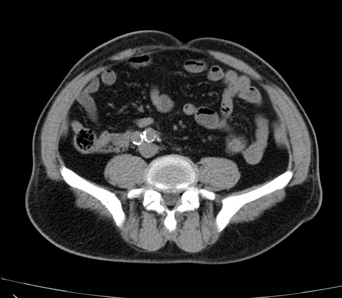 File:Abdominal aortic aneurysm (Radiopaedia 22421-22458 non-contrast 35).jpg