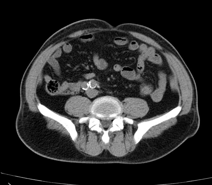 Abdominal aortic aneurysm (Radiopaedia 22421-22458 non-contrast 35).jpg