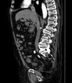 Abdominal aortic aneurysm (Radiopaedia 25855-26001 Sagittal C+ arterial phase 16).jpg