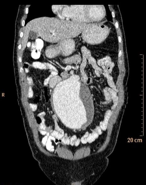 File:Abdominal aortic aneurysm (Radiopaedia 25985-26121 Coronal C+ arterial phase 6).jpg