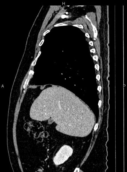 File:Abdominal aortic aneurysm (Radiopaedia 83094-97462 Sagittal renal cortical phase 31).jpg