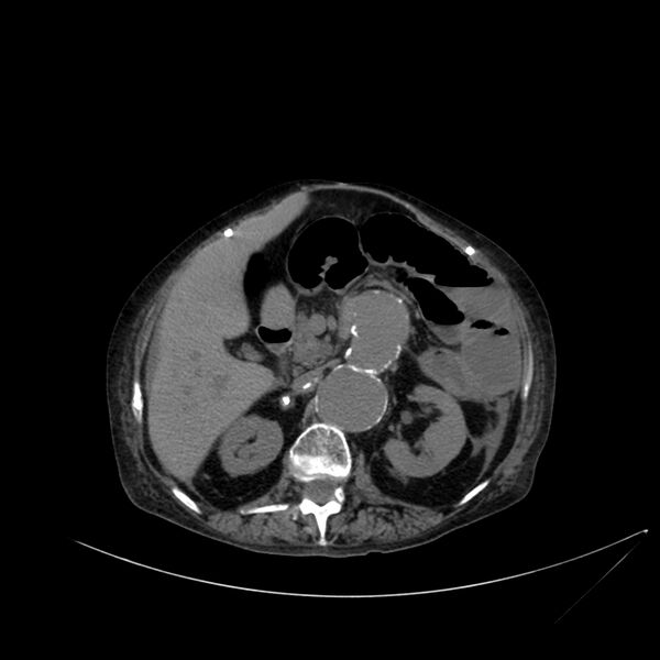 File:Abdominal aortic aneurysm - impending rupture (Radiopaedia 19233-19246 Axial non-contrast 48).jpg