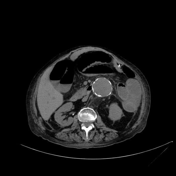 File:Abdominal aortic aneurysm - impending rupture (Radiopaedia 19233-19246 Axial non-contrast 57).jpg