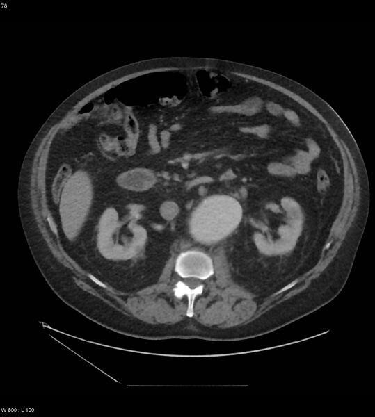 File:Abdominal aortic aneurysm with intramural hematoma then rupture (Radiopaedia 50278-55631 Axial C+ arterial phase 69).jpg