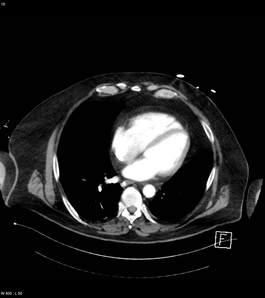 Abdominal aortic aneurysm with intramural hematoma then rupture (Radiopaedia 50278-55632 Axial C+ arterial phase 17).jpg