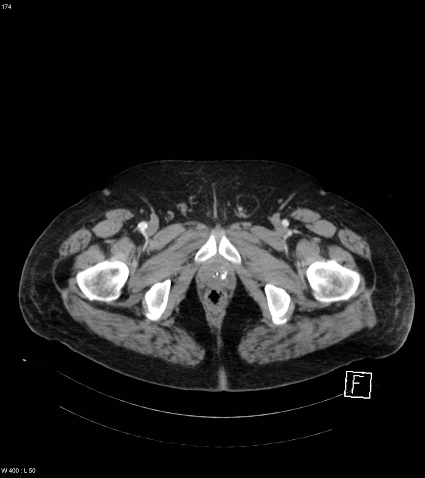 Abdominal aortic aneurysm with intramural hematoma then rupture (Radiopaedia 50278-55632 Axial C+ arterial phase 173).jpg