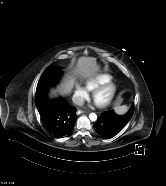 File:Abdominal aortic aneurysm with intramural hematoma then rupture (Radiopaedia 50278-55632 Axial C+ arterial phase 23).jpg