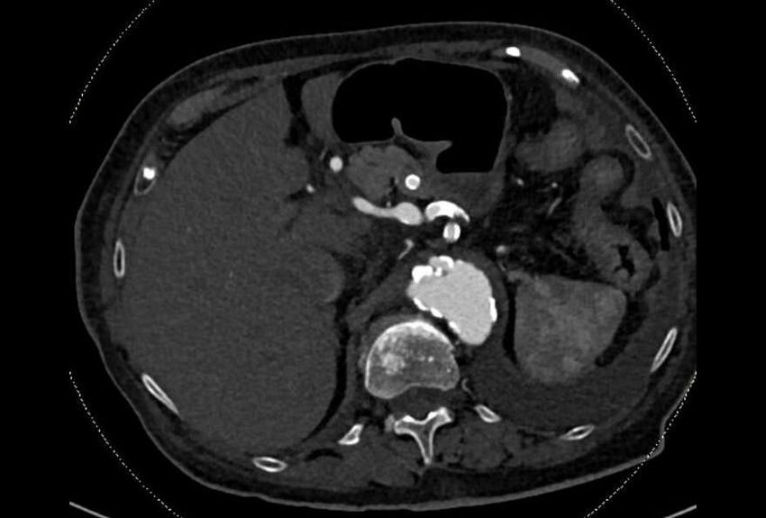 Abdominal aortic aneurysm with thrombus fissuration (Radiopaedia 73192-83919 Axial C+ arterial phase 27).jpg