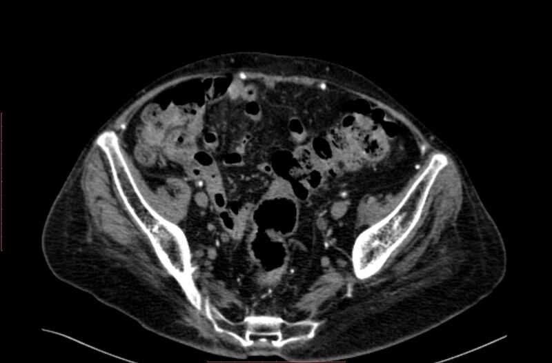 File:Abdominal aortic interposition tube graft and aneurysm thrombosis (Radiopaedia 71438-81857 Axial C+ arterial phase 185).jpg