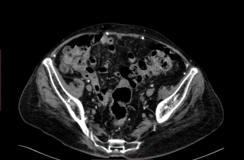 Abdominal aortic interposition tube graft and aneurysm thrombosis (Radiopaedia 71438-81857 Axial C+ arterial phase 185).jpg