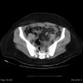 Abdominal wall endometriosis (Radiopaedia 25723-25885 Axial C+ portal venous phase 28).jpg