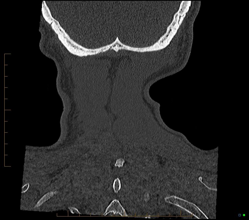 Accessory articulation of cervical transverse processes (Radiopaedia 82715-96933 Coronal non-contrast 108).jpg