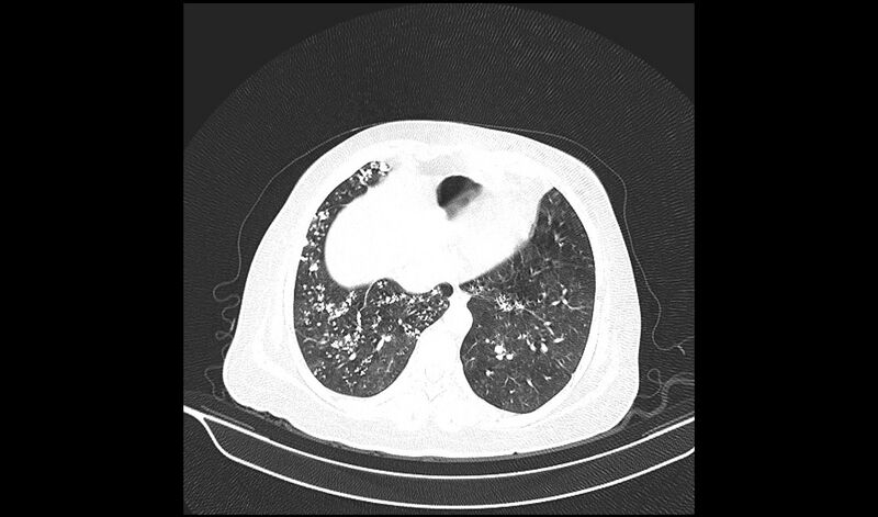 File:Acquired tracheo-esophageal fistula (Radiopaedia 51356-57103 Axial lung window 32).jpg