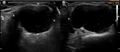 Acromioclavicular joint ganglion and long head of biceps brachii dislocation (Radiopaedia 12938-13043 A 1).jpg