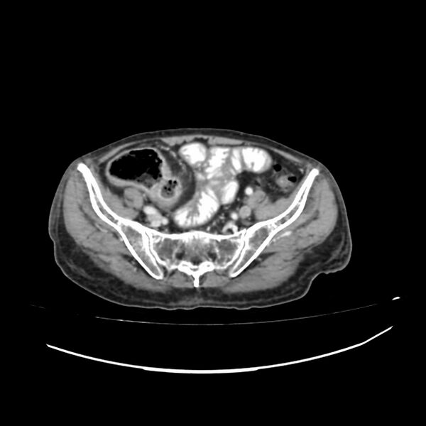 File:Acute-on-chronic Crohn disease with enteroenteric fistula (Radiopaedia 66686-75987 B 52).jpg