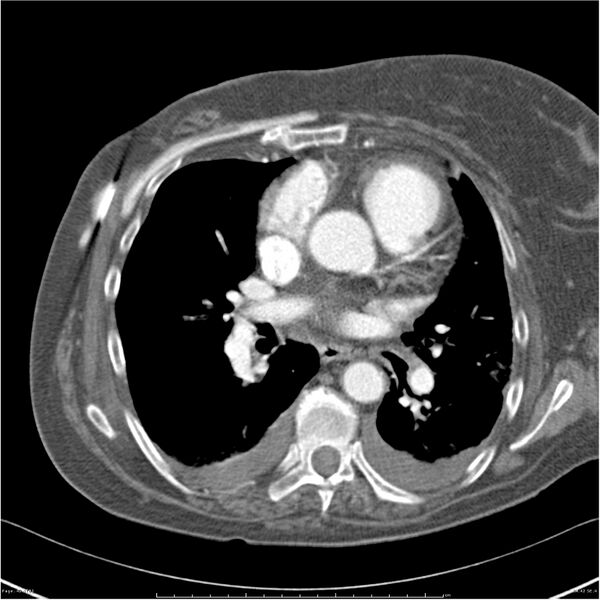 File:Acute-on-chronic pulmonary emboli (Radiopaedia 27925-28169 C+ CTPA 42).jpg