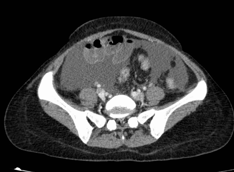 File:Acute Budd-Chiari syndrome (Radiopaedia 60858-68638 Axial C+ portal venous phase 217).jpg