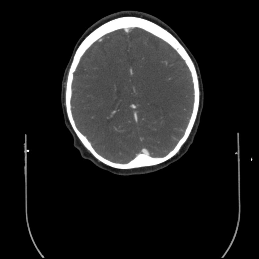 Acute M1 occlusion with ischemic penumbra (CT perfusion) (Radiopaedia 71897-82344 Axial C+ arterial phase thins 16).jpg