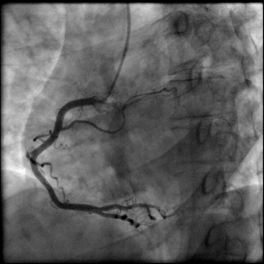 Acute anteroseptal myocardial infarction (Radiopaedia 68409-77946 RAO straight RCA 29).jpg