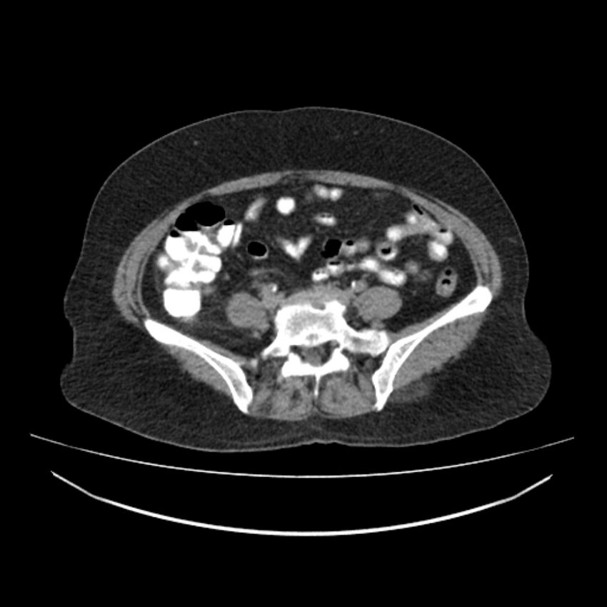Acute appendicits - arrowhead sign (Radiopaedia 84254-99539 Axial C+ delayed 54).jpg