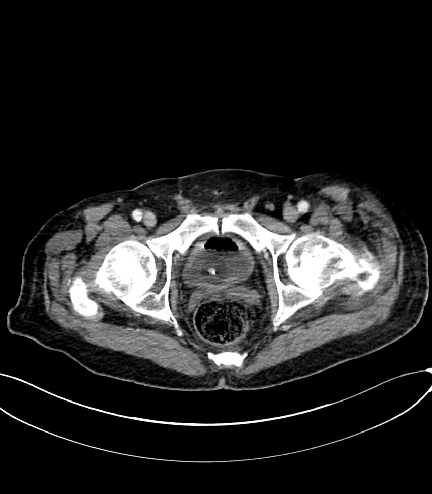 Acute arterial mesenteric ischemia (Radiopaedia 78238-90828 Axial C+ portal venous phase 136).jpg