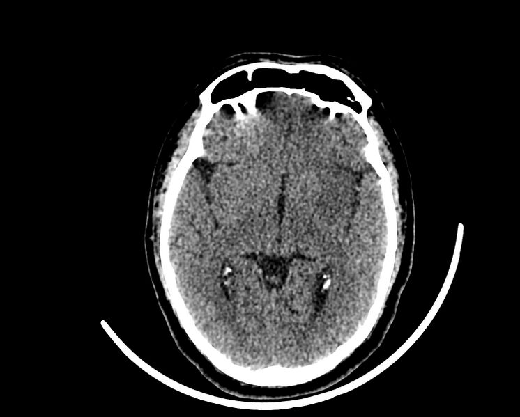 File:Acute cerebral infarct (Radiopaedia 35604-37123 Axial non-contrast 47).jpg