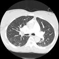 Acute chest syndrome - sickle cell disease (Radiopaedia 42375-45499 Axial lung window 76).jpg